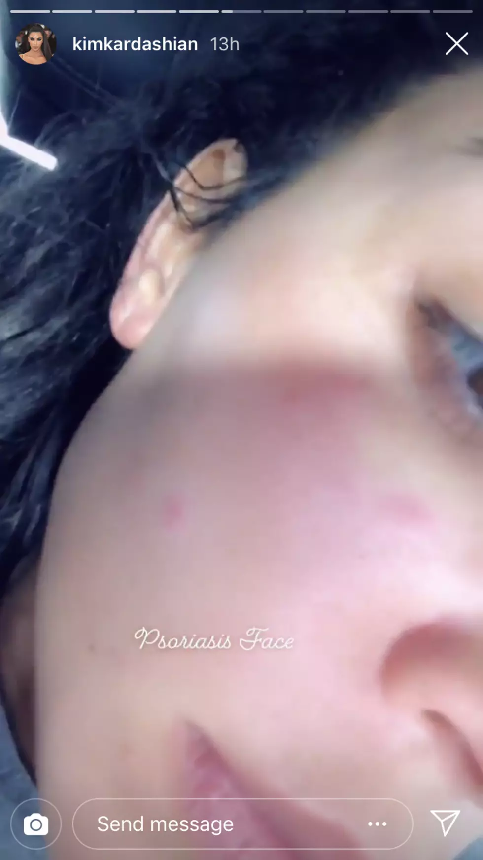 Kim Kardashian Instagram, Kim Kardashian Psoriasis diagnosis, Kim Kardashian Instagram, Kim Kardashian psoriasis instagram